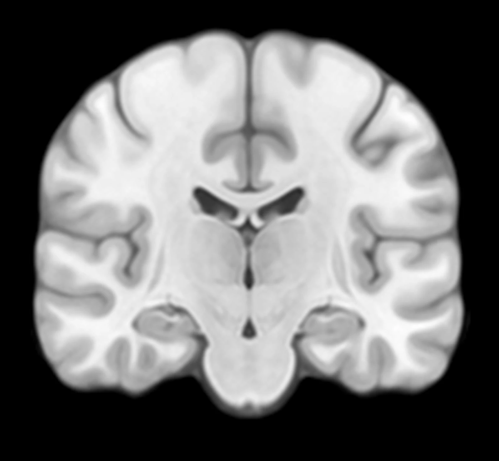 Coronal MRI slice at the level of the hippocampus